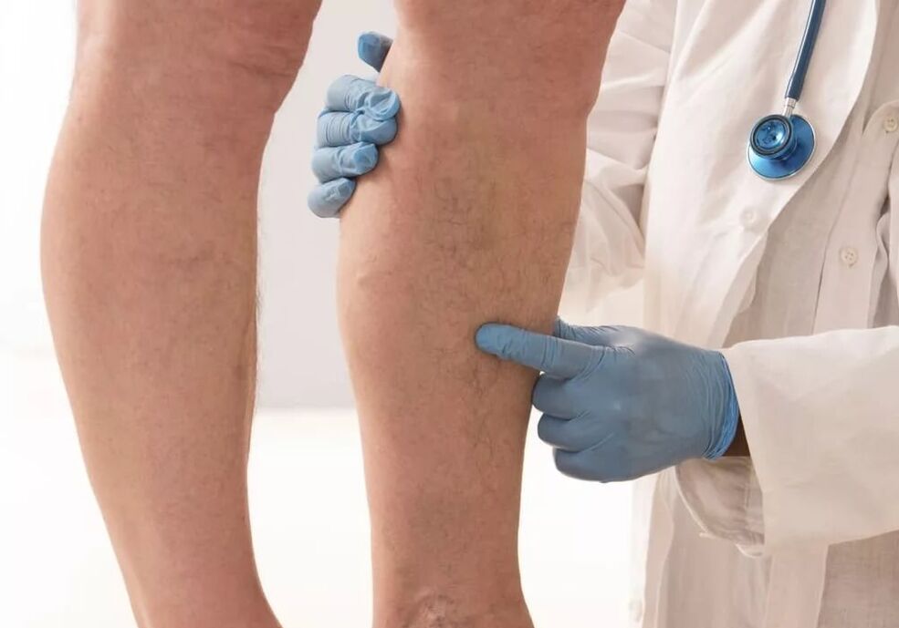 the doctor examines the legs with varicose veins