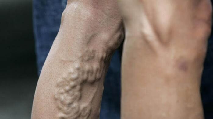 advanced varicose veins