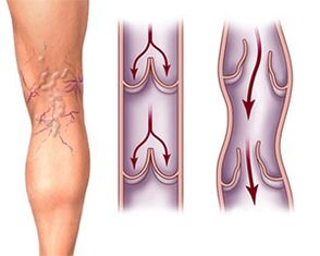 Normal functioning of valves in a healthy vein and pathology of valves in a varicose vein