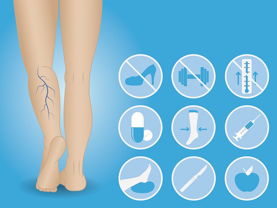 Varicose veins of the lower limbs