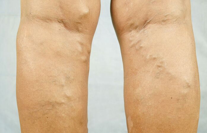 Varicose veins in the legs are a reason to consult a phlebologist