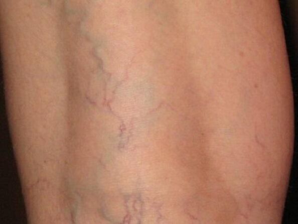Type of varicose veins