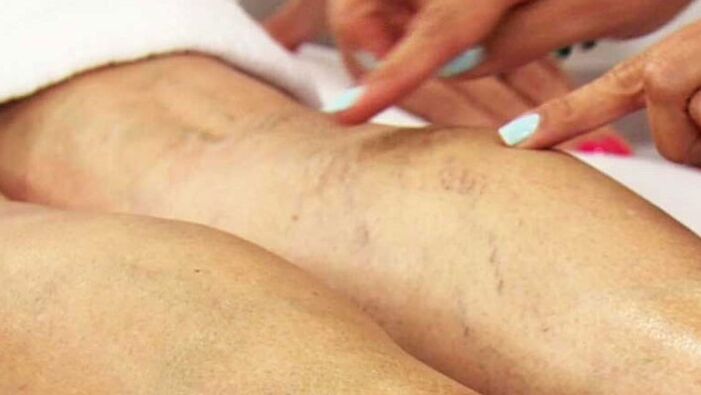 Varicose veins of the lower ends