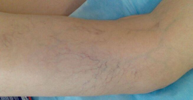 varicose veins
