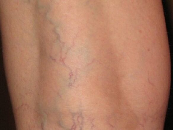 Phase of varicose veins