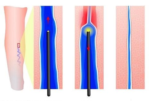Laser coagulation