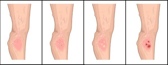 The degree of varicose veins