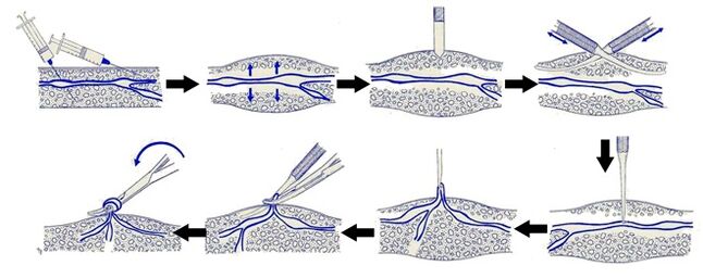 Varadi operation