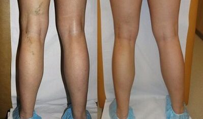 Laser treatment of the photo of the varicose veins before and after