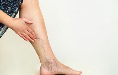 how to treat varicose veins of the lower extremities