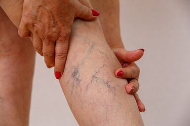 varicose veins of the lower limbs