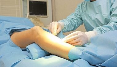 For what symptoms is surgery for varicose veins prescribed