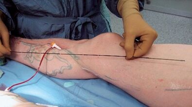 How surgery for varicose veins is performed