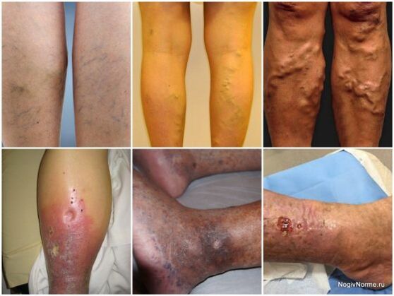 The degree of damage to varicose veins